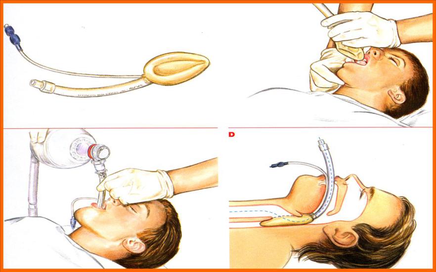 圖2 喉罩通氣道插入方法