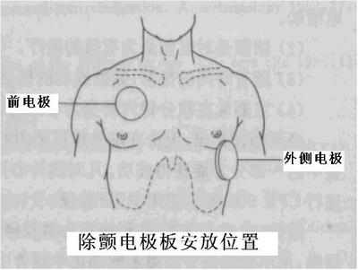 胸外電極放置部位