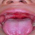 舌齒齦疼痛性粟粒至水皰