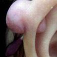 耳孔處腫物 耳孔處腫物