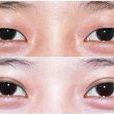 雙眼皮手術
