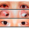 眼球後退綜合症特殊類型斜視