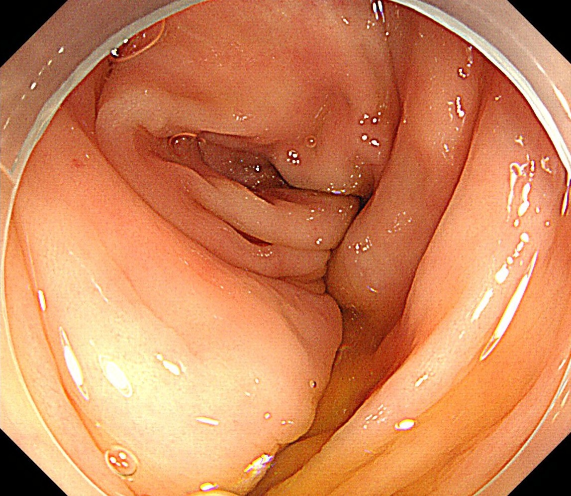 脫垂的直腸黏膜