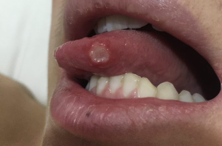 舌頭潰瘍