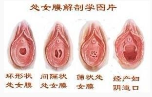 處女膜不同類型解剖學圖片