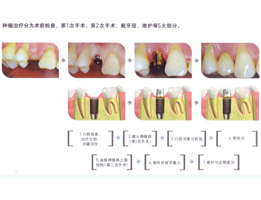 種牙流程圖
