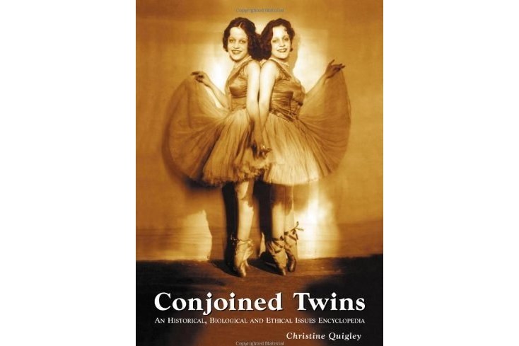 Conjoined Twins Conjoined Twins