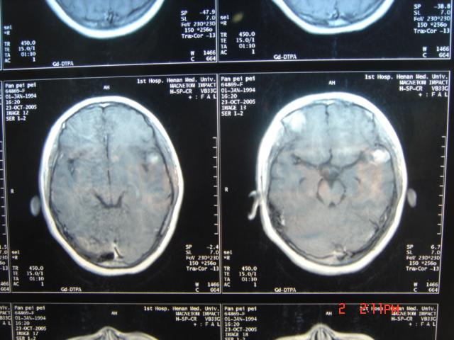 惡性腦膠質瘤CT影像表現