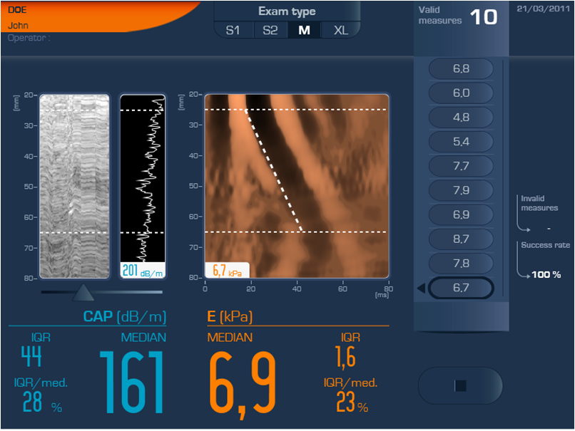 FibroScan