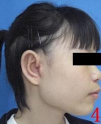 外耳再造的術前術後對比