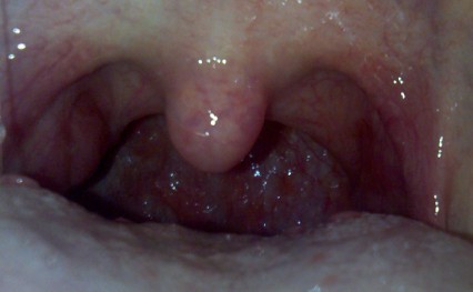 咽喉潰瘍