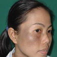 太田斑 太田斑