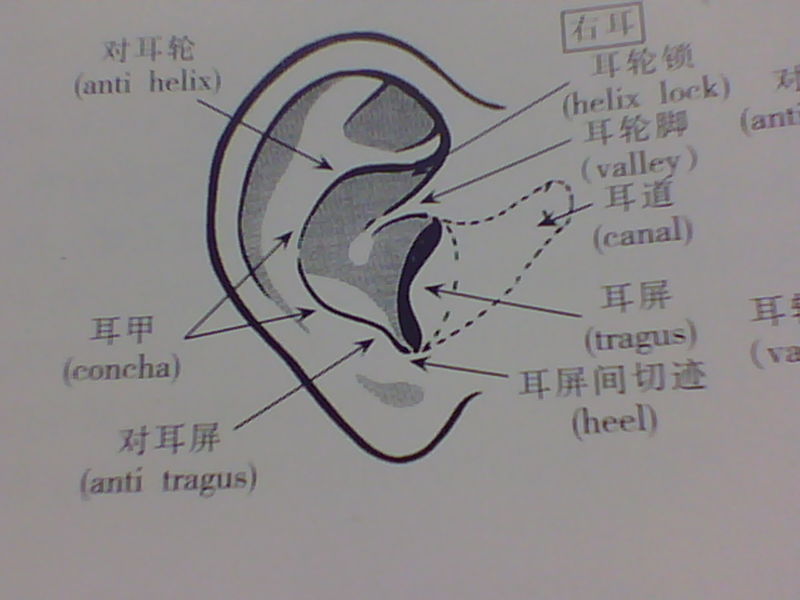 先天性耳蝸畸形