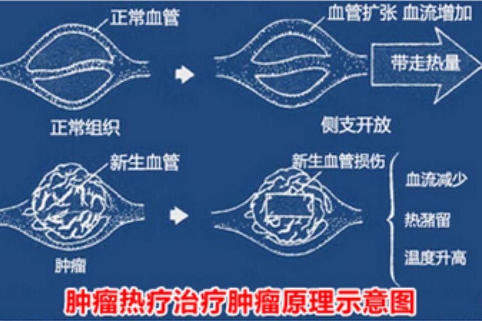 腫瘤熱療 腫瘤熱療