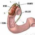 膽囊切除術 膽囊切除術