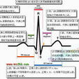 心電圖U波 心電圖U波