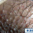 陰毛囊炎 陰毛囊炎