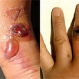 碳蛆熱 碳蛆熱
