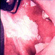 口腔黏膜白斑病