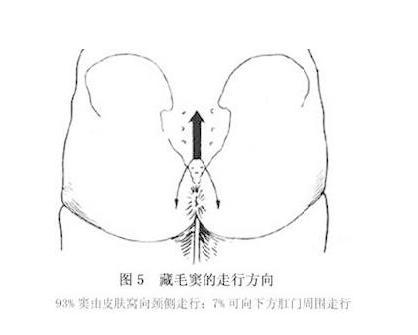 皮毛竇 皮毛竇