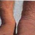 脛前和足部堅硬的非凹陷性水腫斑塊