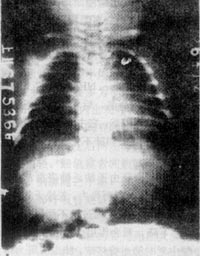新生兒肺透明膜病