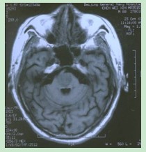 腦幹梗死MRI表現：T1WI相