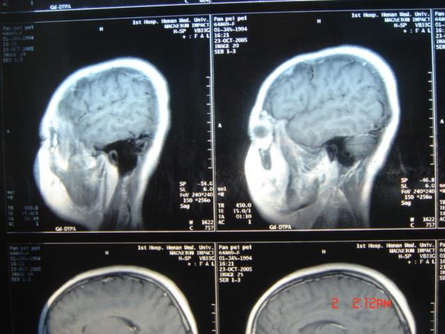 惡性腦膠質瘤CT影像表現