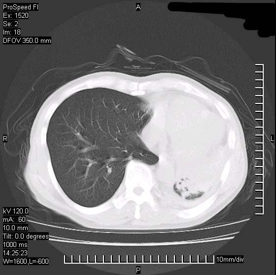 肺葉氣腫圖像