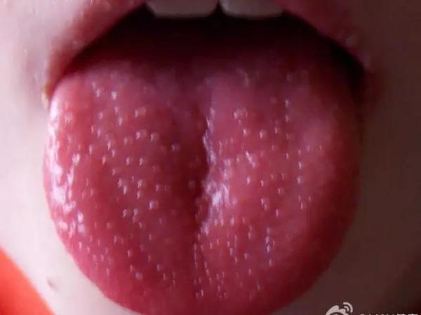 草莓舌