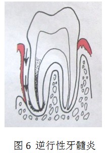 牙周病變對牙髓的影響
