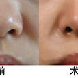 隆鼻子 隆鼻子