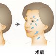 除皺針 除皺針
