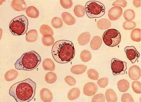 繼發性鐵粒幼細胞性貧血
