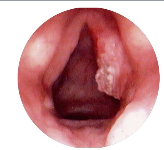 喉良性腫瘤-喉乳頭狀瘤