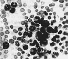 毛細胞性白血病(圖6)