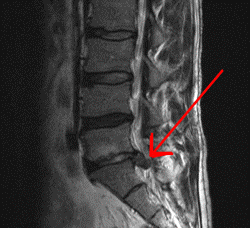 經MRI拍攝的椎間盤突出症
