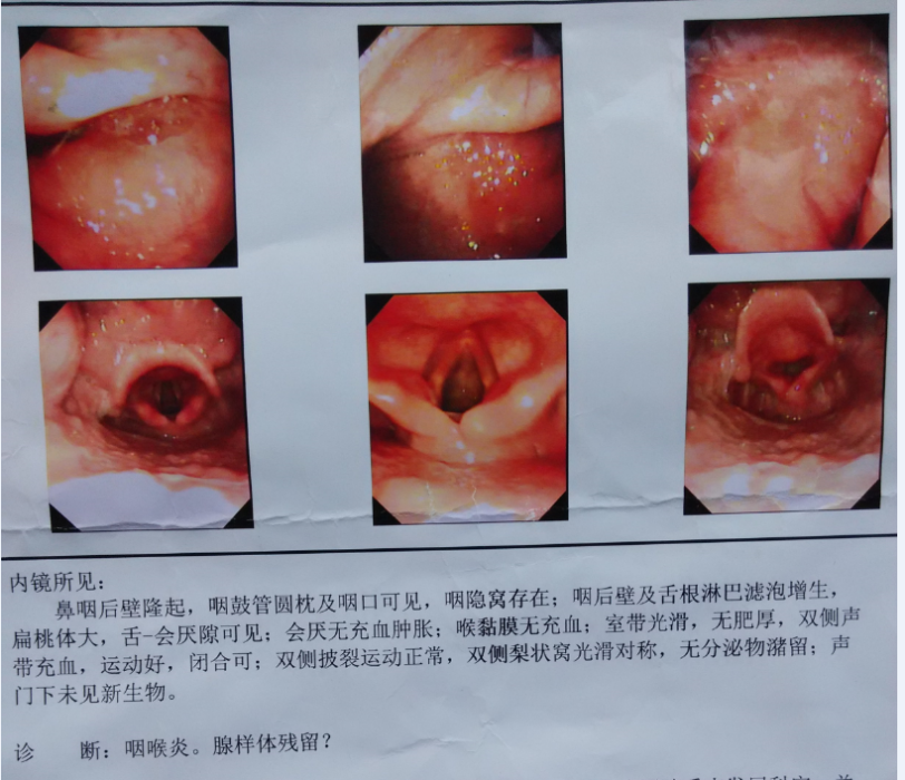 腺樣體殘留 腺樣體殘留