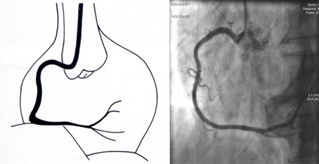 右冠狀動脈造影常用的投照體位