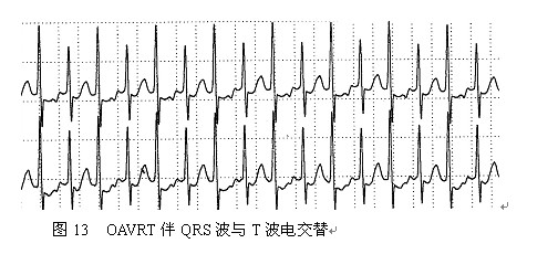 QRS與T波電交替
