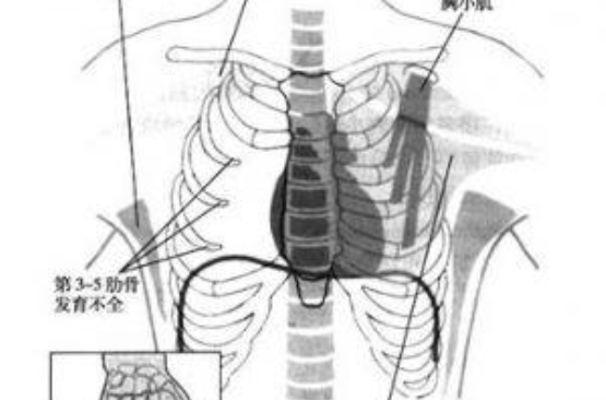 胸大肌無發育並短指綜合徵胸壁缺損修復術
