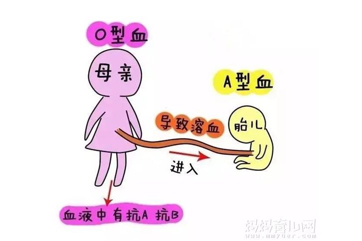 ABO溶血 ABO溶血