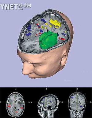 腦部的功能性核磁共振影像