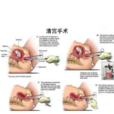 清宮手術 清宮手術