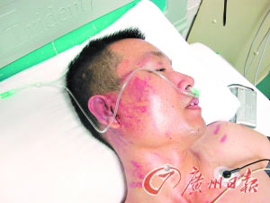李偉光被毆打後頭部傷痕累累。