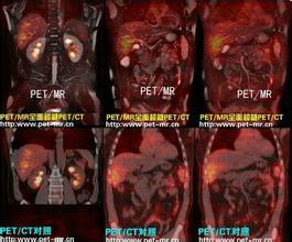 PET/CT與PET/MR成像對比圖