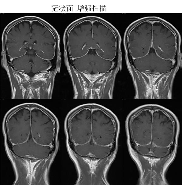 低顱壓綜合症