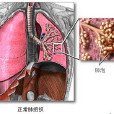 喘息性肺炎