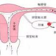 輸卵管性不孕症(輸卵管性不孕)