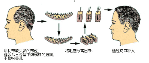 自體毛髮種植